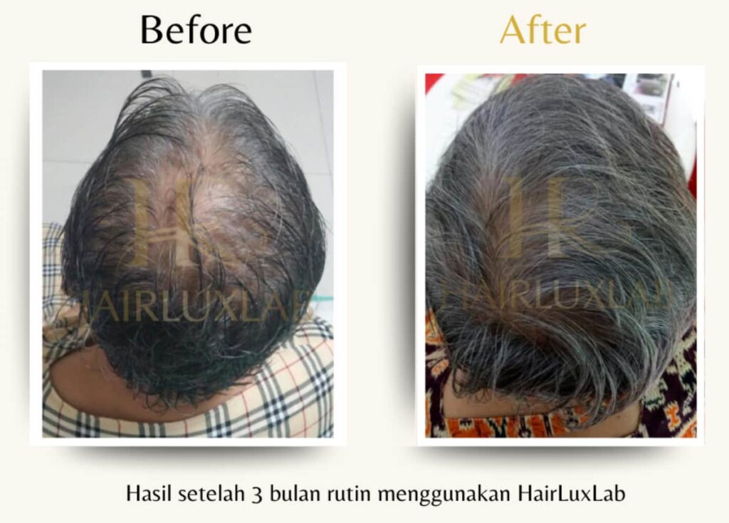 Before dan after pengguna HairLuxLab wanita setelah 3 bulan pemakaian rutin