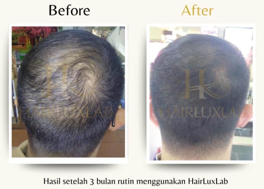 Before dan after pengguna HairLuxLab pria setelah 3 bulan pemakaian rutin