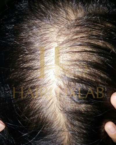 Rambut Rontok Sebelum