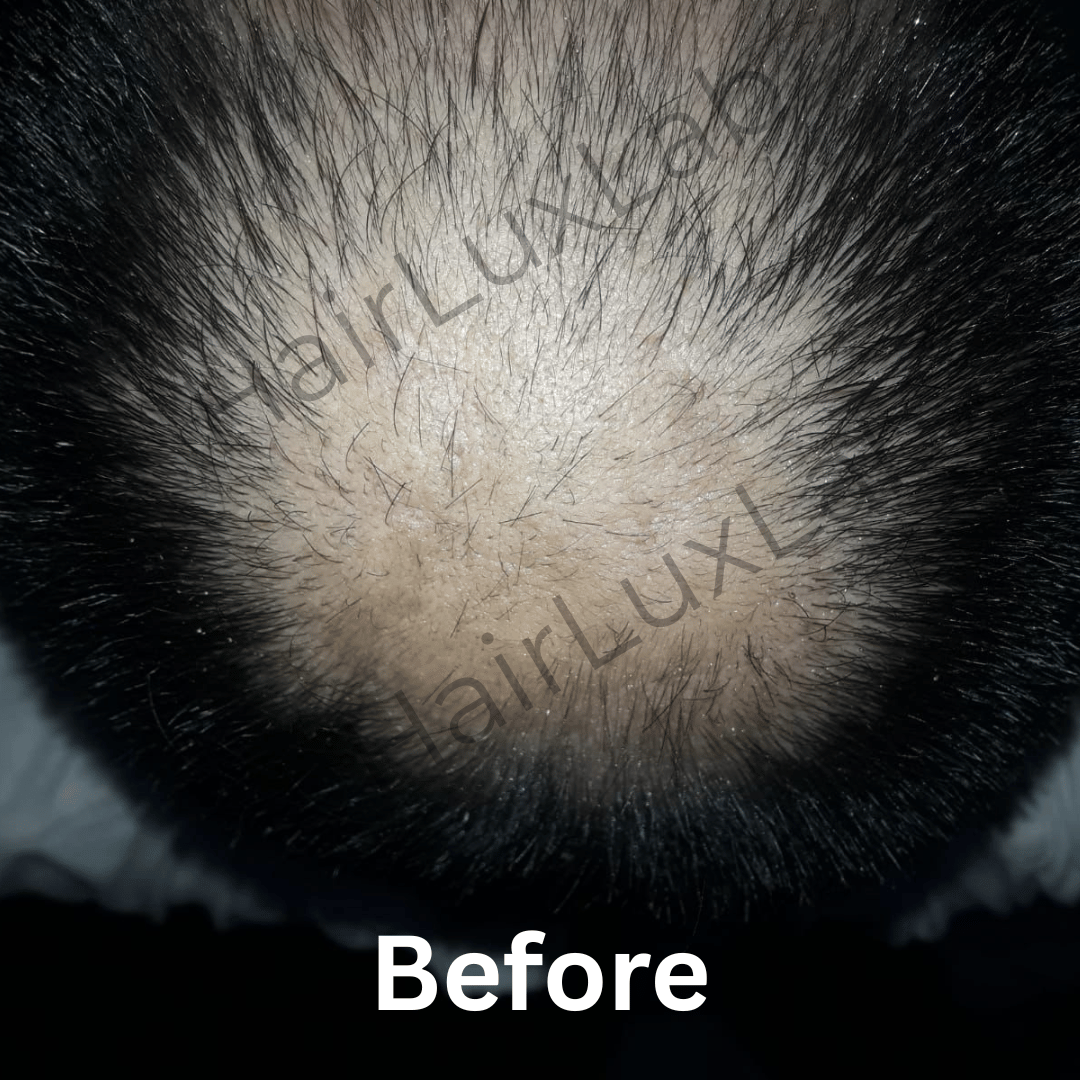 Rambut Menipis Sebelum Perawatan